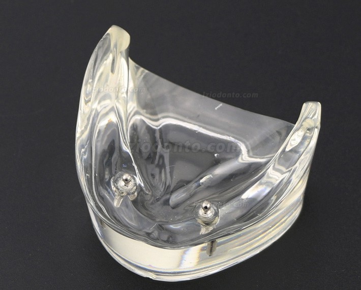 Dentes dentais modelo sobredentadura inferior com 2 implantes 6002 01